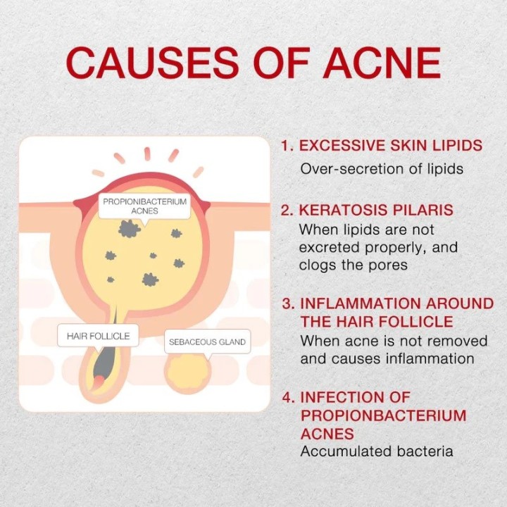 DR WU Mandelik Intensive Anti-Acne Serum