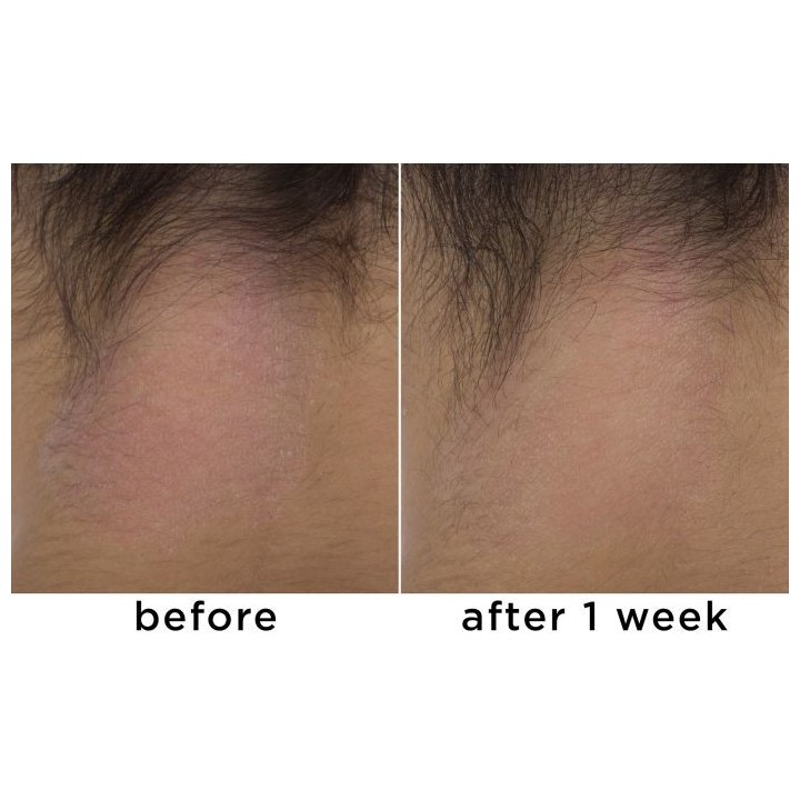 Calm Cool + Corrected 1% Colloidal Oatmeal Eczema + Dermatitis Clinical Repair Balm