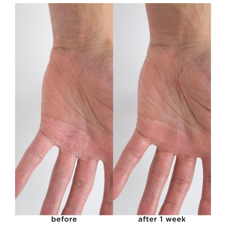 Calm Cool + Corrected 1% Colloidal Oatmeal Eczema + Dermatitis Clinical Repair Balm