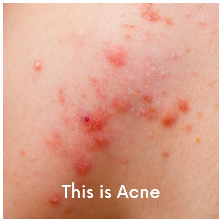 Ain't Misbehavin' Medicated AHA/BHA Acne Cleanser